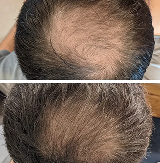 Root Activator Shampoo™ - Sale 28 real result 1